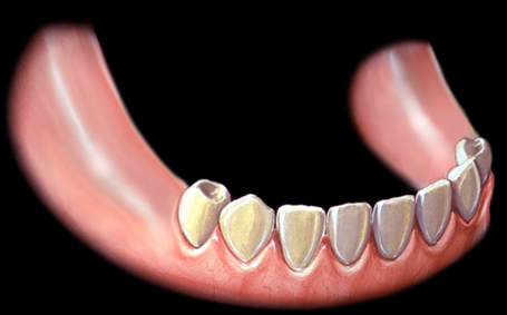 Periodontal 假牙